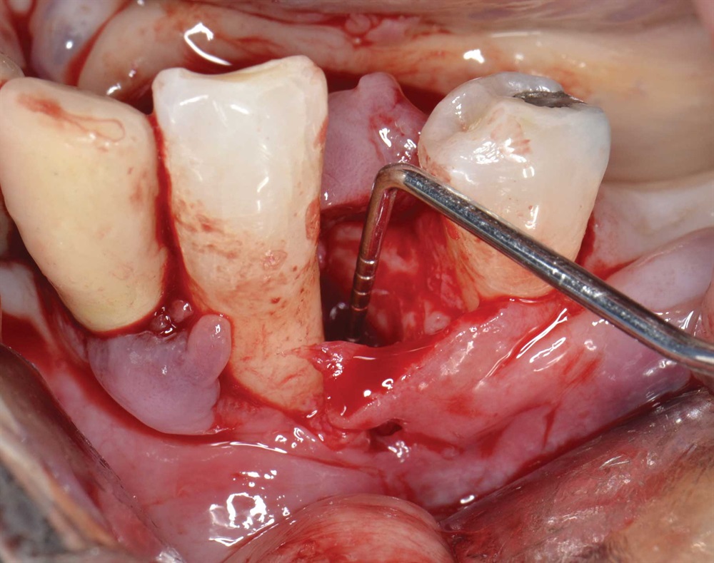 Tarquini_Periodontal intrabony defect